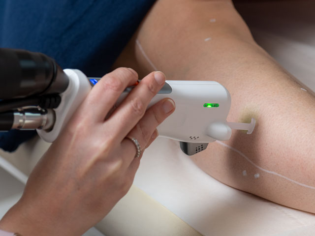 Epilation laser au Centre Esthétique Inkermann à Niort