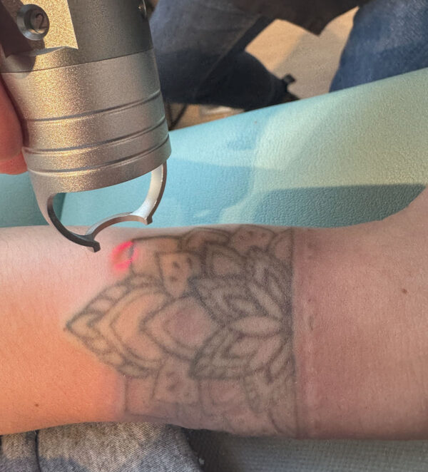 Détatouage au laser au Carré Esthétique Inkermann de Niort